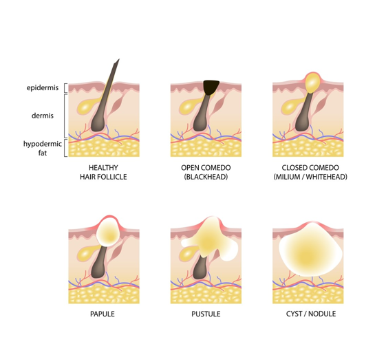 Understand your acne by learning the type of acne you have