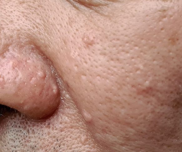 Seb Hyperplasia 583x487
