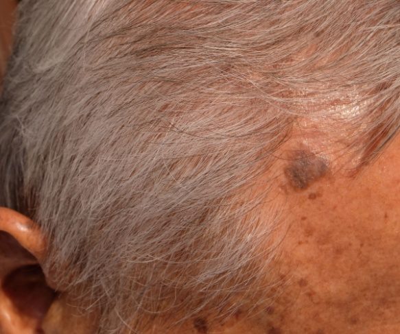 Seborrheic keratosis diagnosis and treatment options | Brisbane