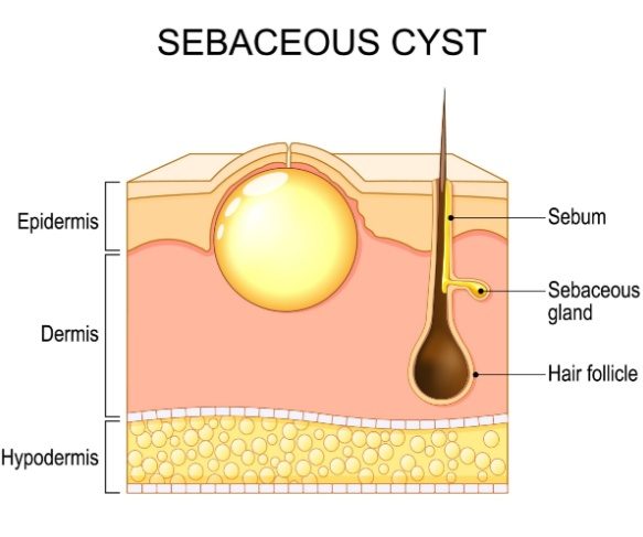 Sebaceous hyperplasia explained, what it is and can it be treated? Brisbane laser solutions for sebaceous hyperplasia