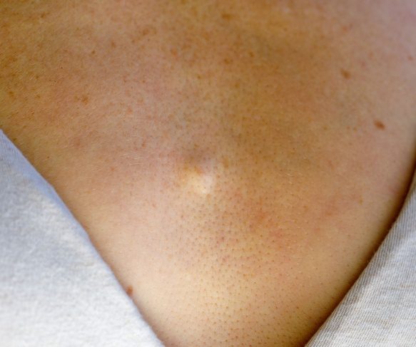 What is sebaceous hyperplasia? Can they be removed safely? How to get a skin lesion diagnosis Brisbane