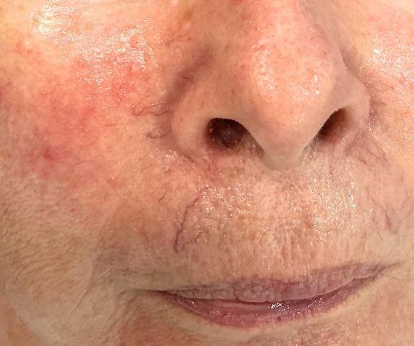 small, visible blood vessels laser treatment