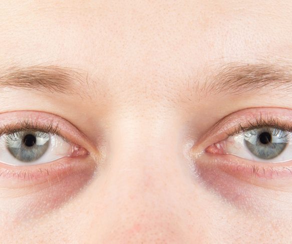 Hollowing around eyes can be assessed and treatment options can be discussed during a consultation.