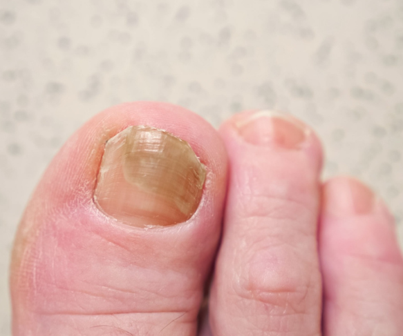 Suffering from fungal toenail? Get advice and laser treatment for fungal toenail infection, Brisbane