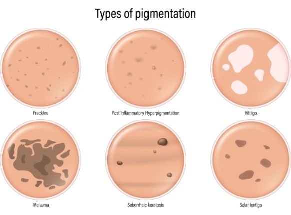 How to tell if you're skin spot is seborrheic keratosis or age spots (a.k.a. solar lentigines)