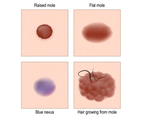 What is a mole? Types of moles? When should you get a mole checked? Brisbane Cosmetic Mole Removal