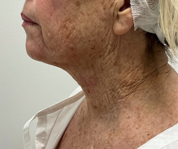 Treatment for uneven skin tone