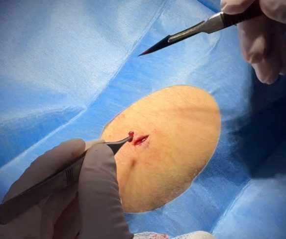 Remove unwanted lumps like lipoma in Brisbane | Queensland Skin and Laser clinic