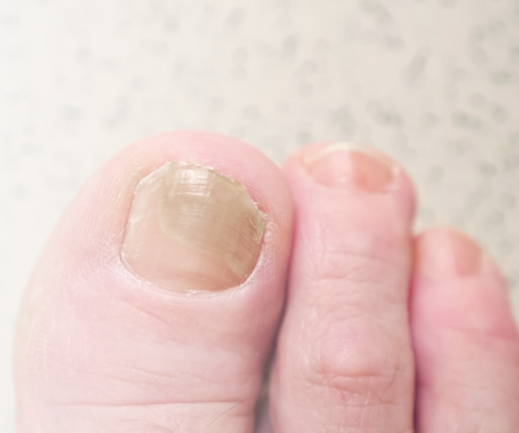 Fungal Toenail Infection Brisbane Banner